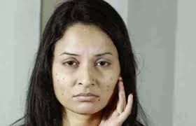 ব্রণের দাগ দূর করার উপায়
