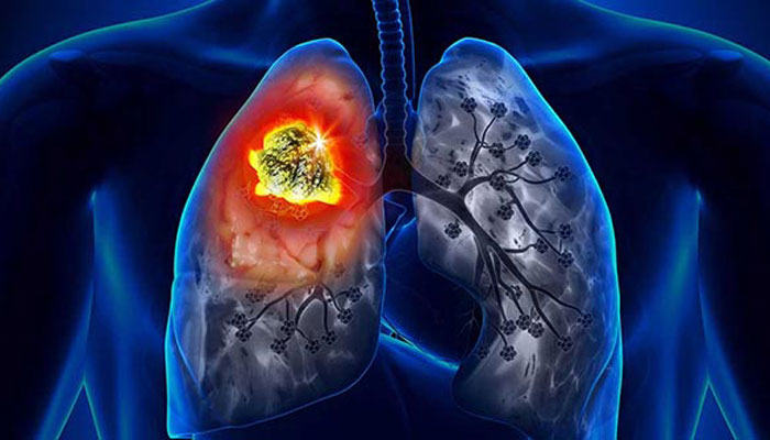 যেসব কারণে হতে পারে ফুসফুস ক্যান্সার