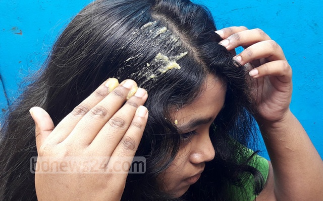 ঘরোয়া উপাদানে খুশকি দূর