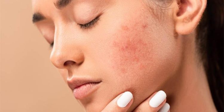 যে ৩ উপায় দূর হতে পারে ব্রণের দাগ