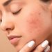 যে ৩ উপায় দূর হতে পারে ব্রণের দাগ