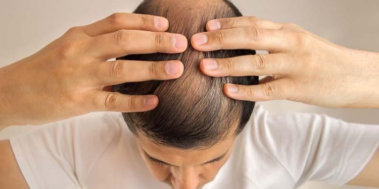 টাক পড়া রোধে ঘরোয়া সমাধান