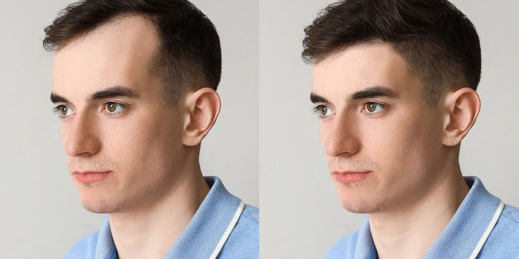 টাক মাথায় চুল গজানোর ৪ উপায়