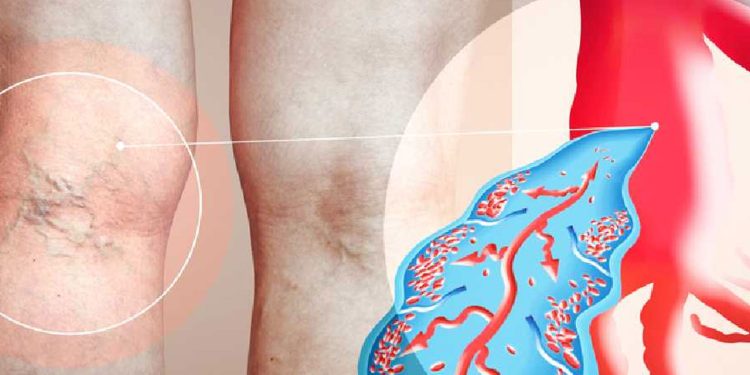 হাঁটলেই পা ফুলে যাচ্ছে? এই উপসর্গ দেখলে সতর্ক হোন