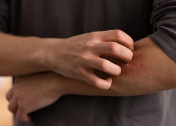মশার কামড়ে চুলকানি? জেনে নিন দূর করার উপায়