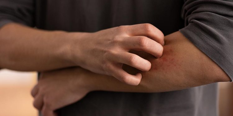 মশার কামড়ে চুলকানি? জেনে নিন দূর করার উপায়