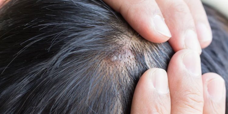 মাথার ত্বকে ব্রণ হলে কী করবেন?